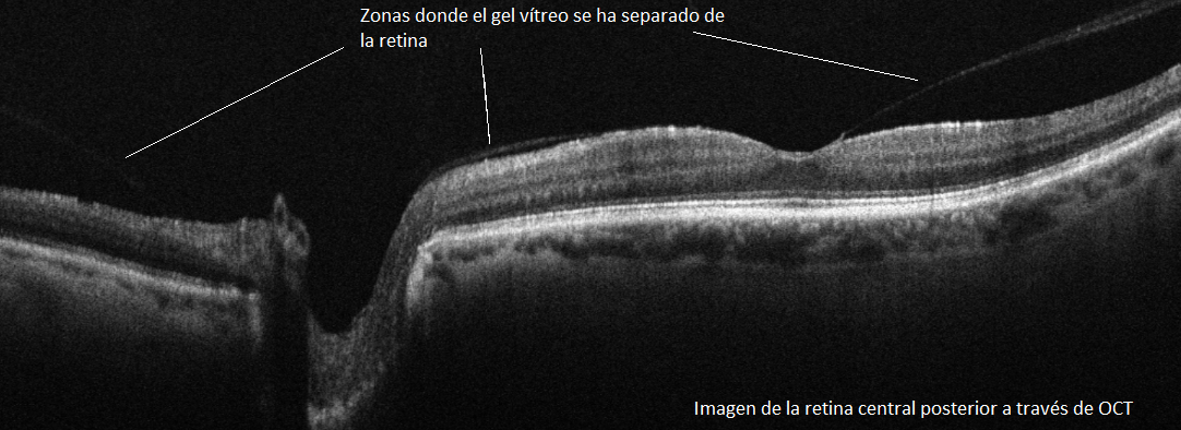 caso desprendimiento vitreo posterior