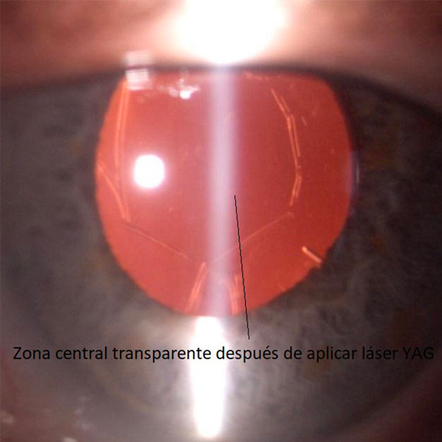 caso capsulotomía YAG post